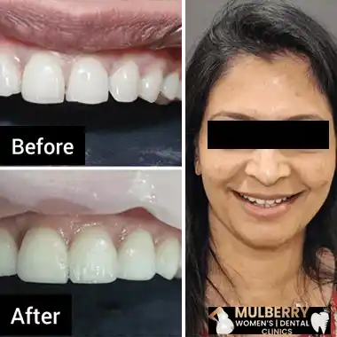 Before After Images
