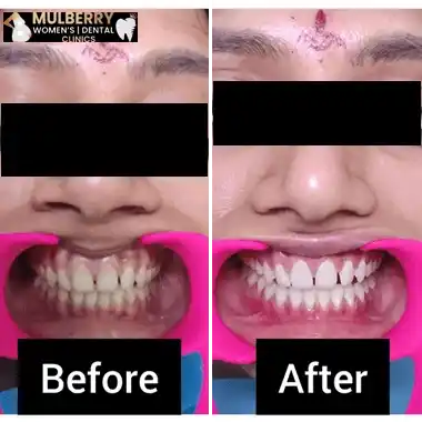 Before After Images