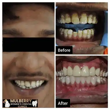 Before After Images