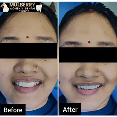 Before After Images