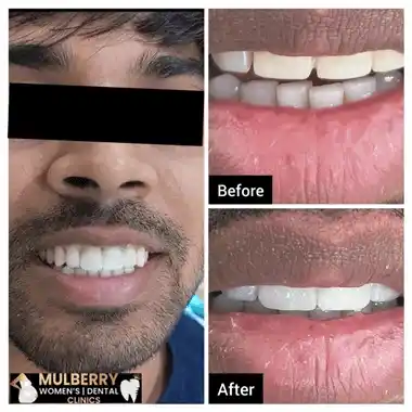 Before After Images