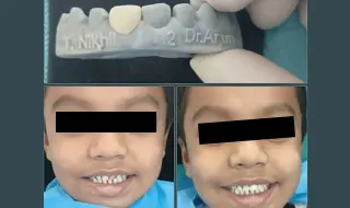 3D Printing of Dental Crowns Treatment