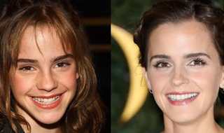 Smile Makeovers