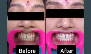Teeth Whitening